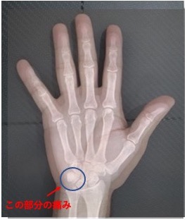 手のひらの痛み（豆状三角関節障害とは？）